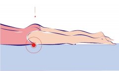 Varikozus medence erek műtéti kezelése - A kismedencei szervek varikózisának megelőzése